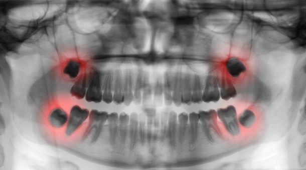 What is a wisdom tooth?
