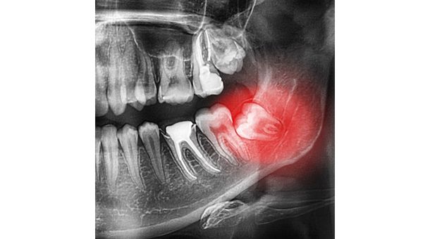  How Painful is Getting Wisdom Teeth Removed