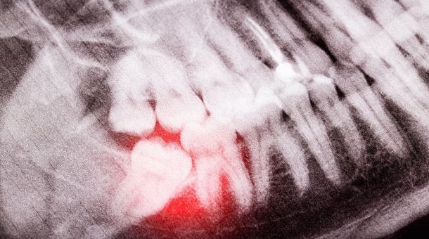 How effective is a wisdom tooth removal?